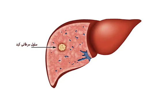 علایم سرطان کبد ضروری و خیرهکننده برای تشخیص سریع