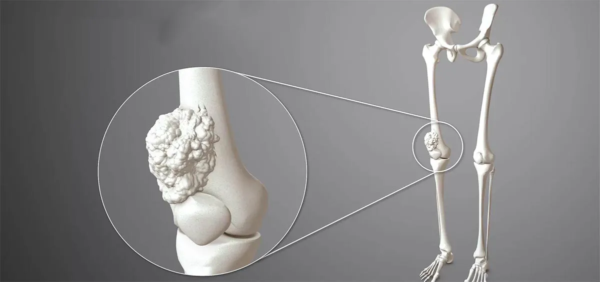 توده استخوانی خیره‌کننده و بهترین روش‌های درمان آسان