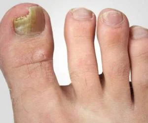 دلیل افتادن ناخن پا: نکات ضروری و آسان برای درمان سریع