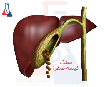 علائم سنگ کیسه صفرا: راهنمای ضروری و آسان برای تشخیص سریع