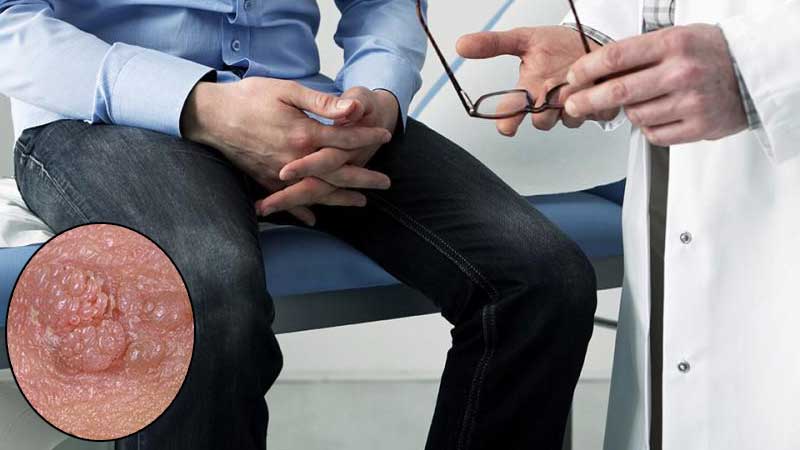 بهترین دکتر زگیل تناسلی hpv