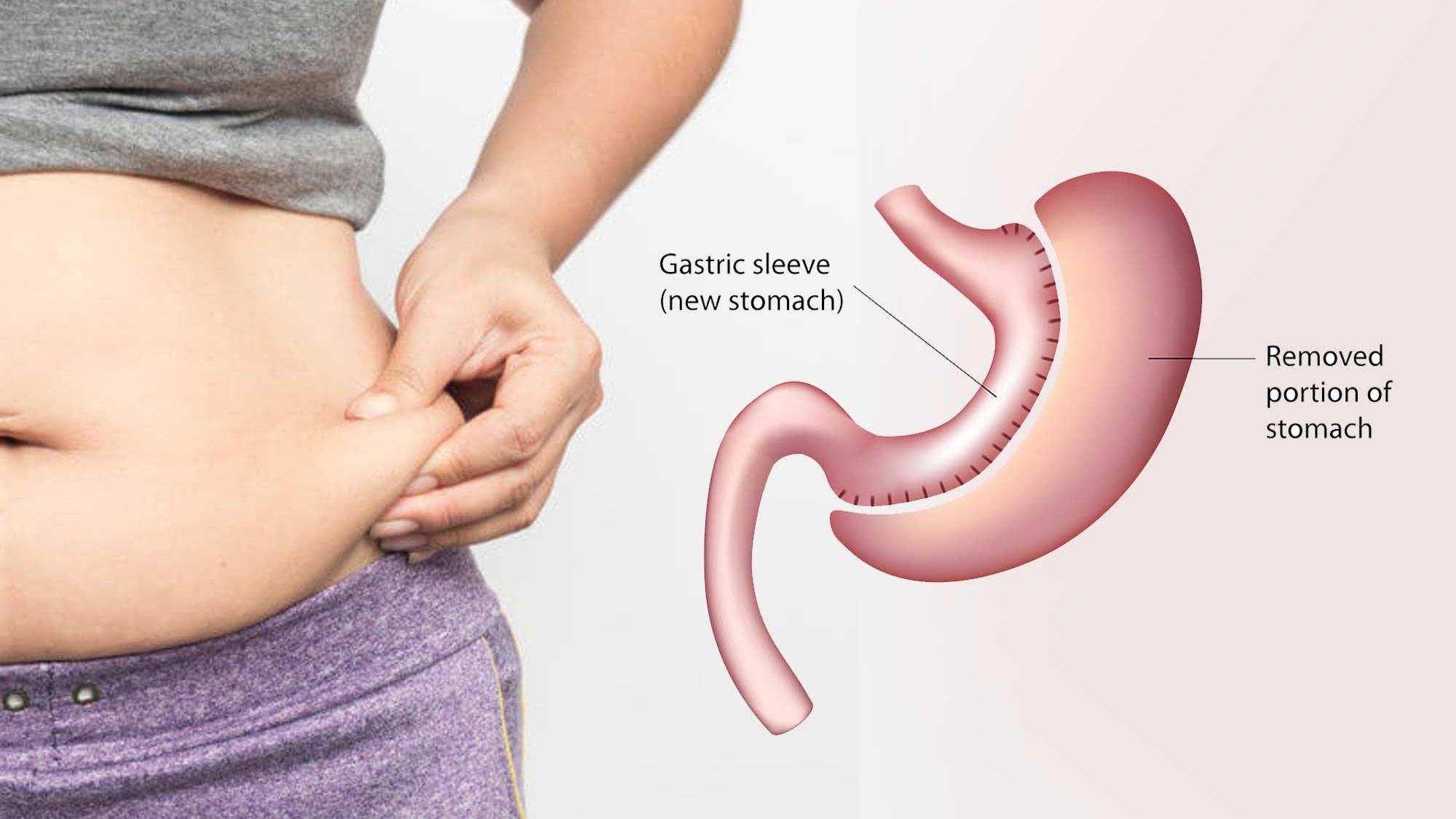 بهترین جراحی لاغری برای افرادی که اضافه‌ وزن مفرط دارند