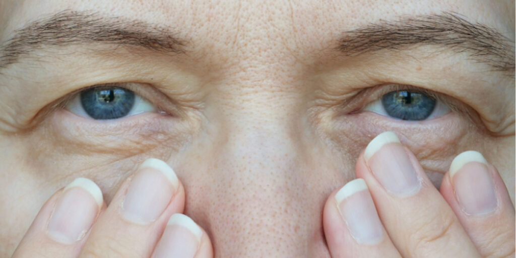 بوتاکس ابرو