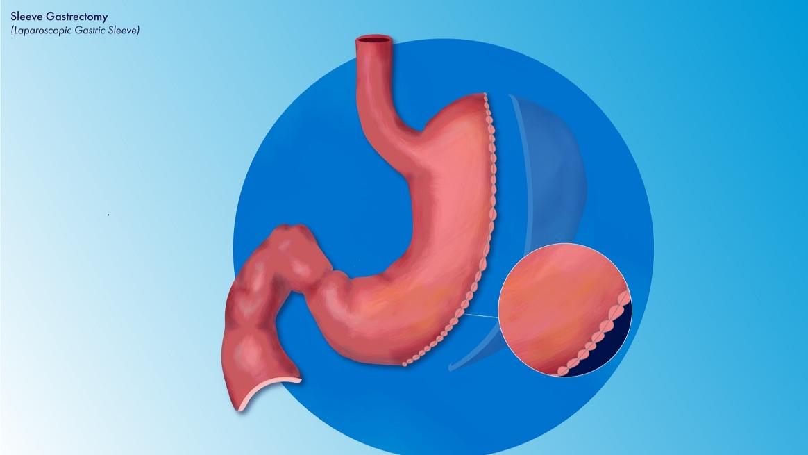 جراحی‌های باریاتریک