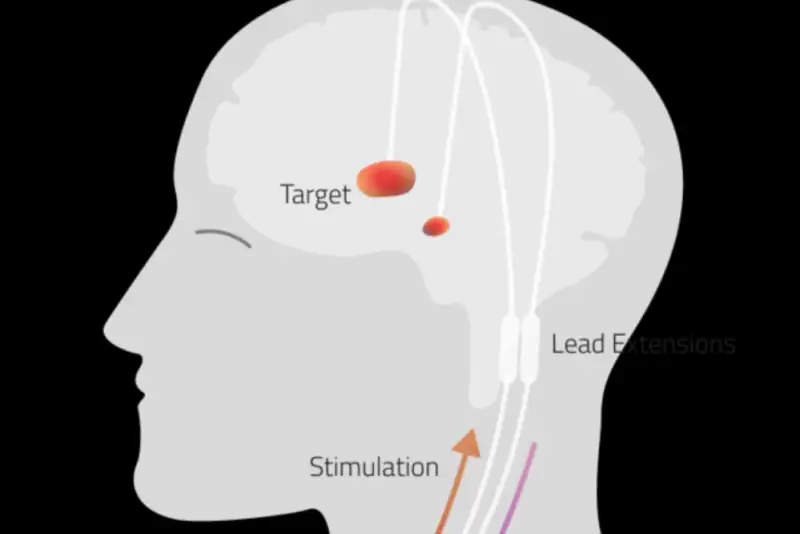 انقلاب در درمان بیماری های مغزی: بومی سازی کامل فناوری تحریک عمقی مغز در ایران