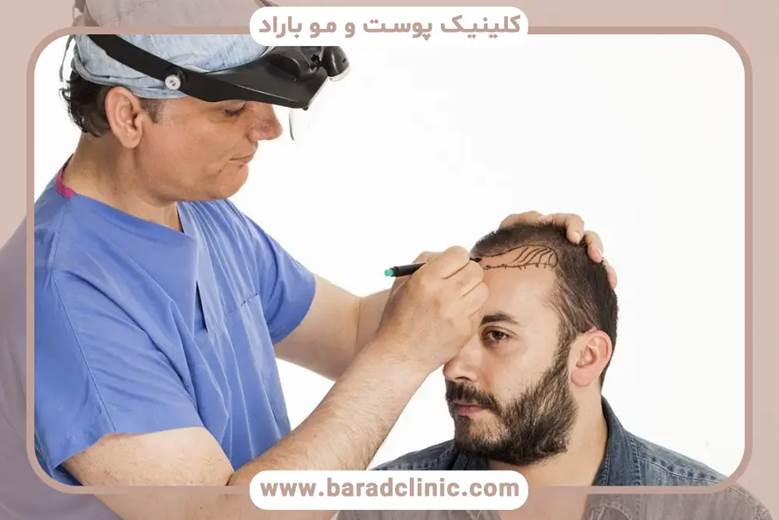 کاشت مو نقدی و اقساطی